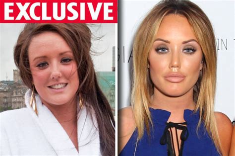 geordie shore before surgery.